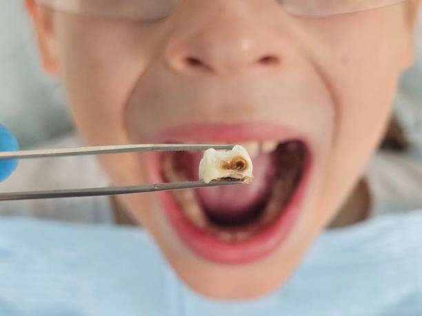Best Emergency Broken Tooth Repair in Kirksville, MO