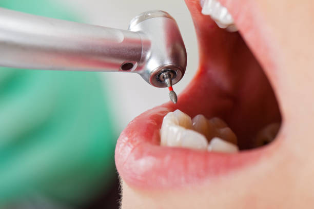 Best Emergency Wisdom Teeth Removal in Kirksville, MO